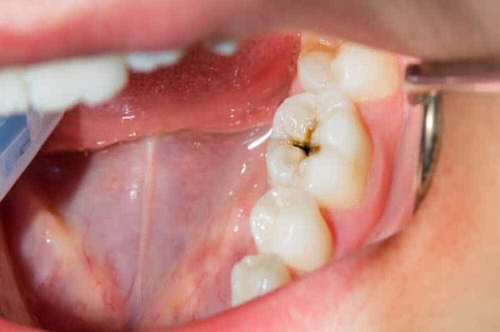 Root Canal